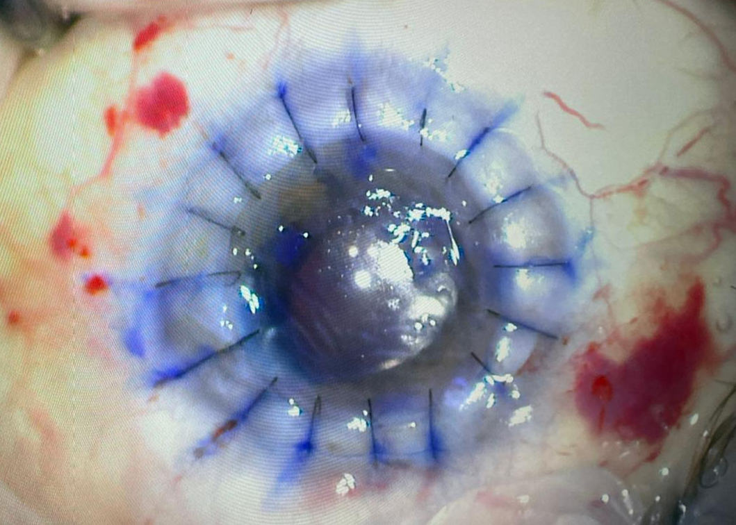 Eye Bank Jordan